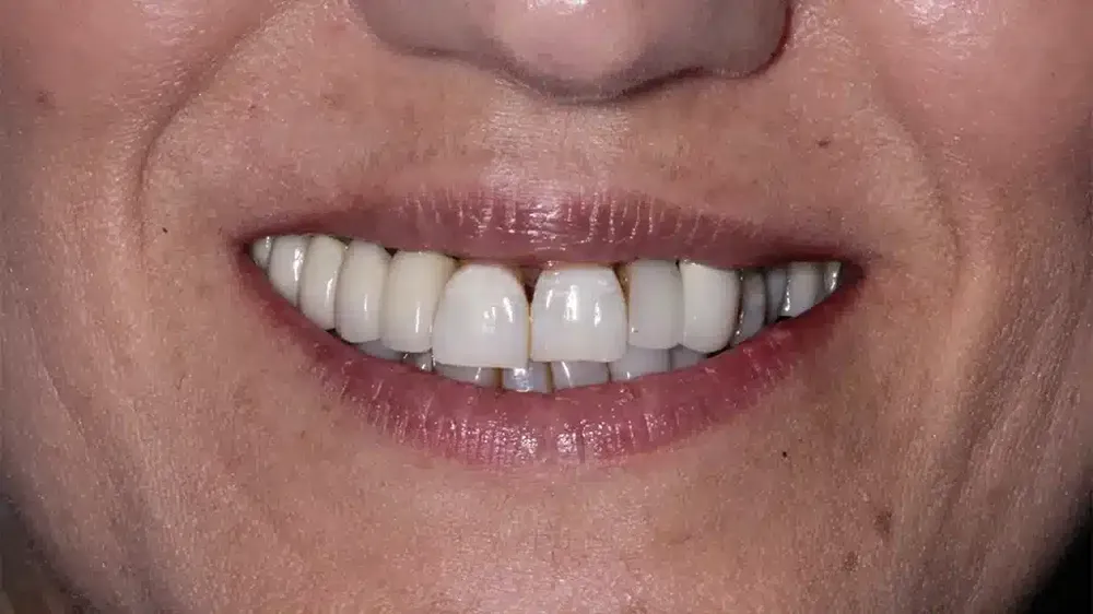 before after smile makeover 1