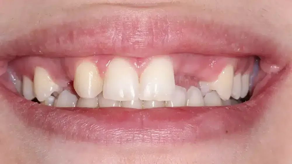 before after smile makeover 10
