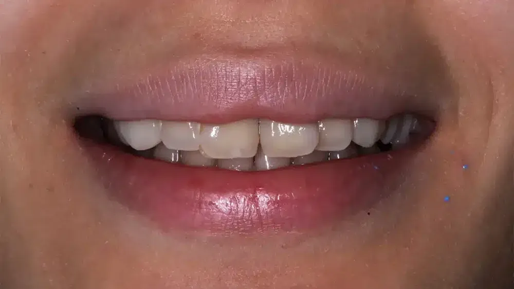 before after smile makeover 6