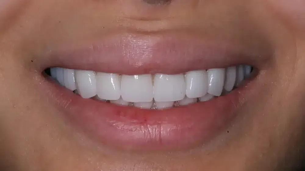 before after smile makeover 7