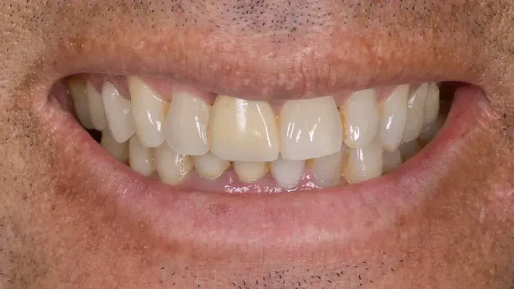 before after smile makeover 8