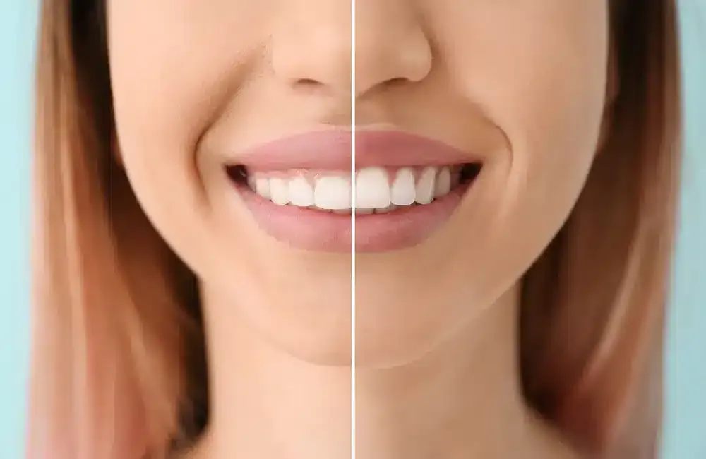 Crown Lengthening