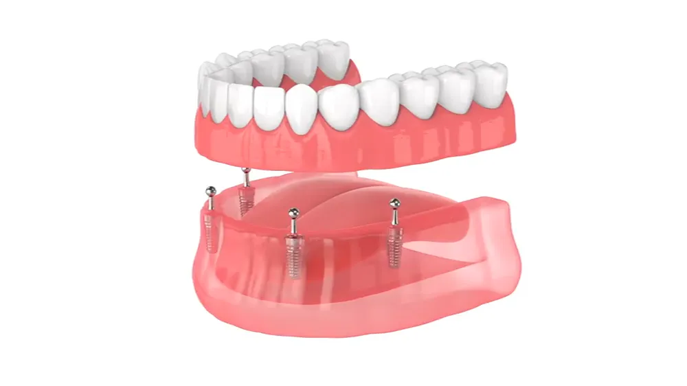 snap in implant dentures