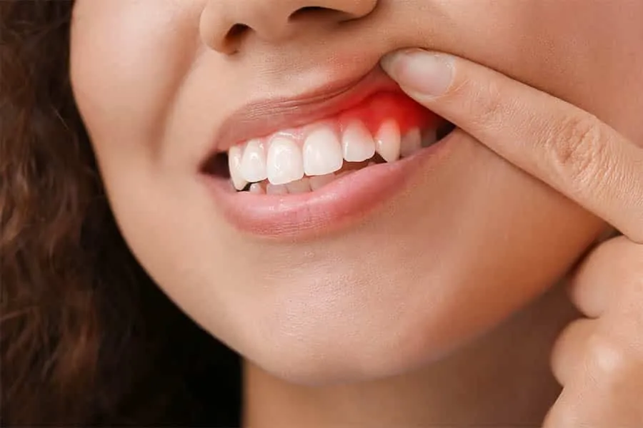 Gingivectomy