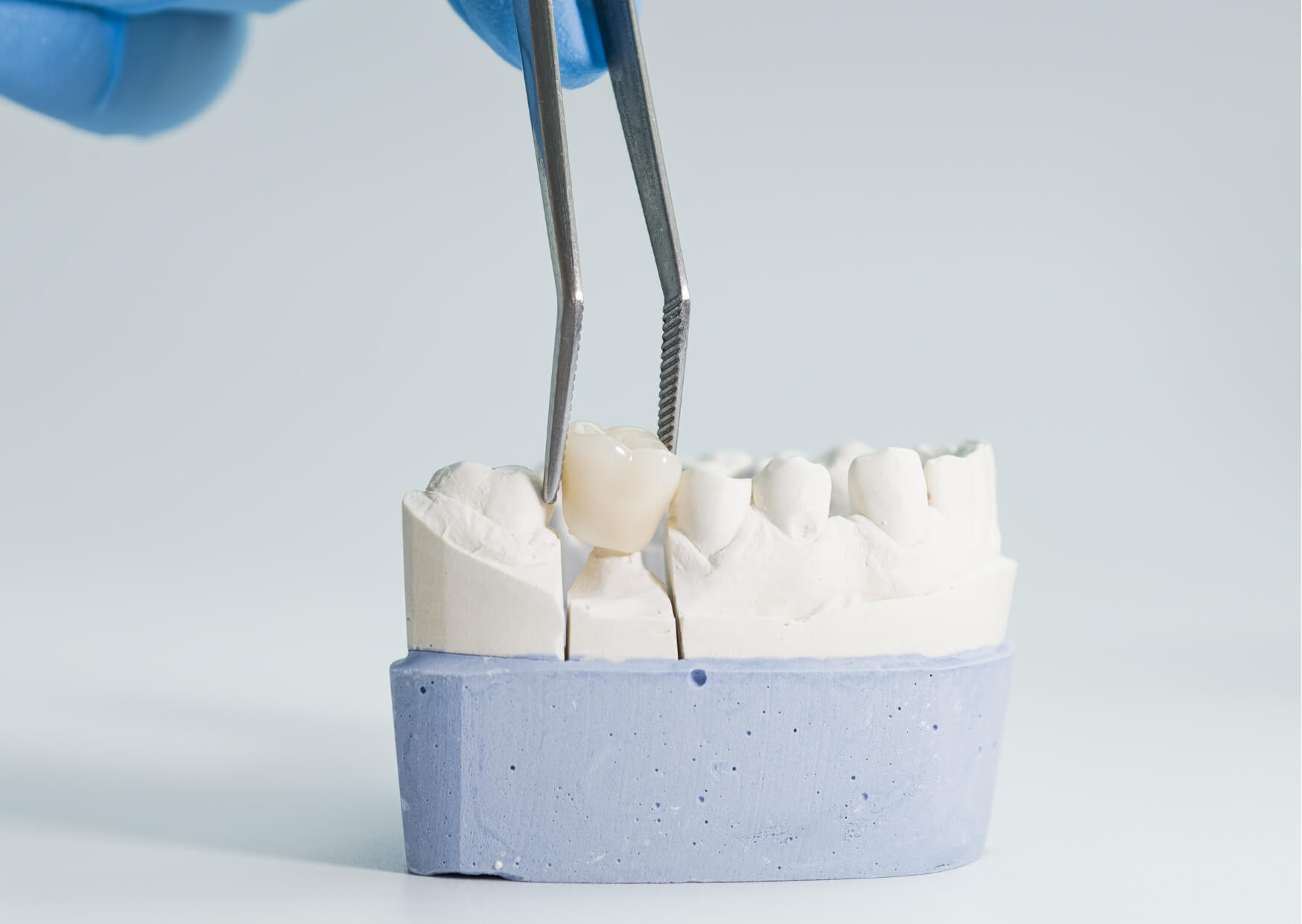 Dental crown placed on a tooth model to illustrate the difference between choosing a dental crown or a filling for tooth restoration.