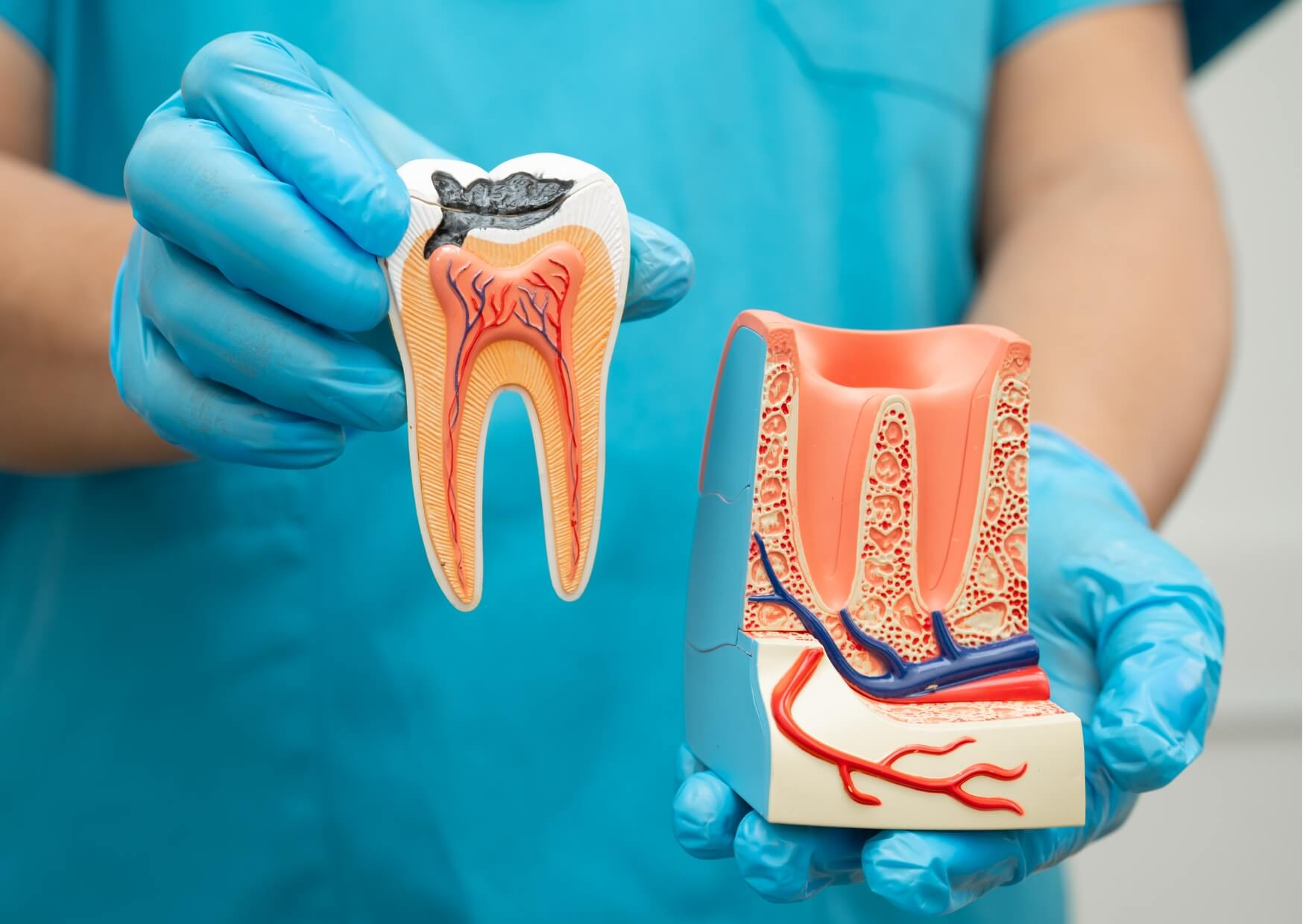 Dental model showing an infected tooth and jawbone anatomy to explain the difference between root canal treatment and tooth extraction.