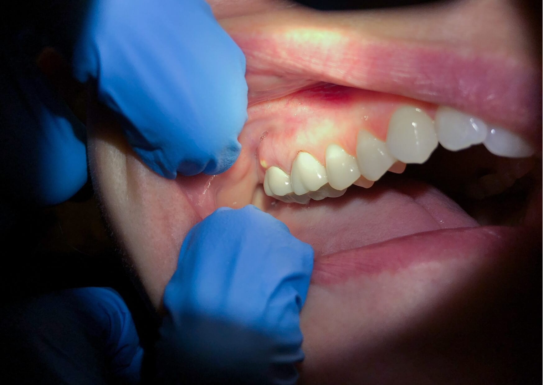 Close-up of a swollen gum with a visible dental abscess near a tooth, illustrating a common sign of tooth infection.