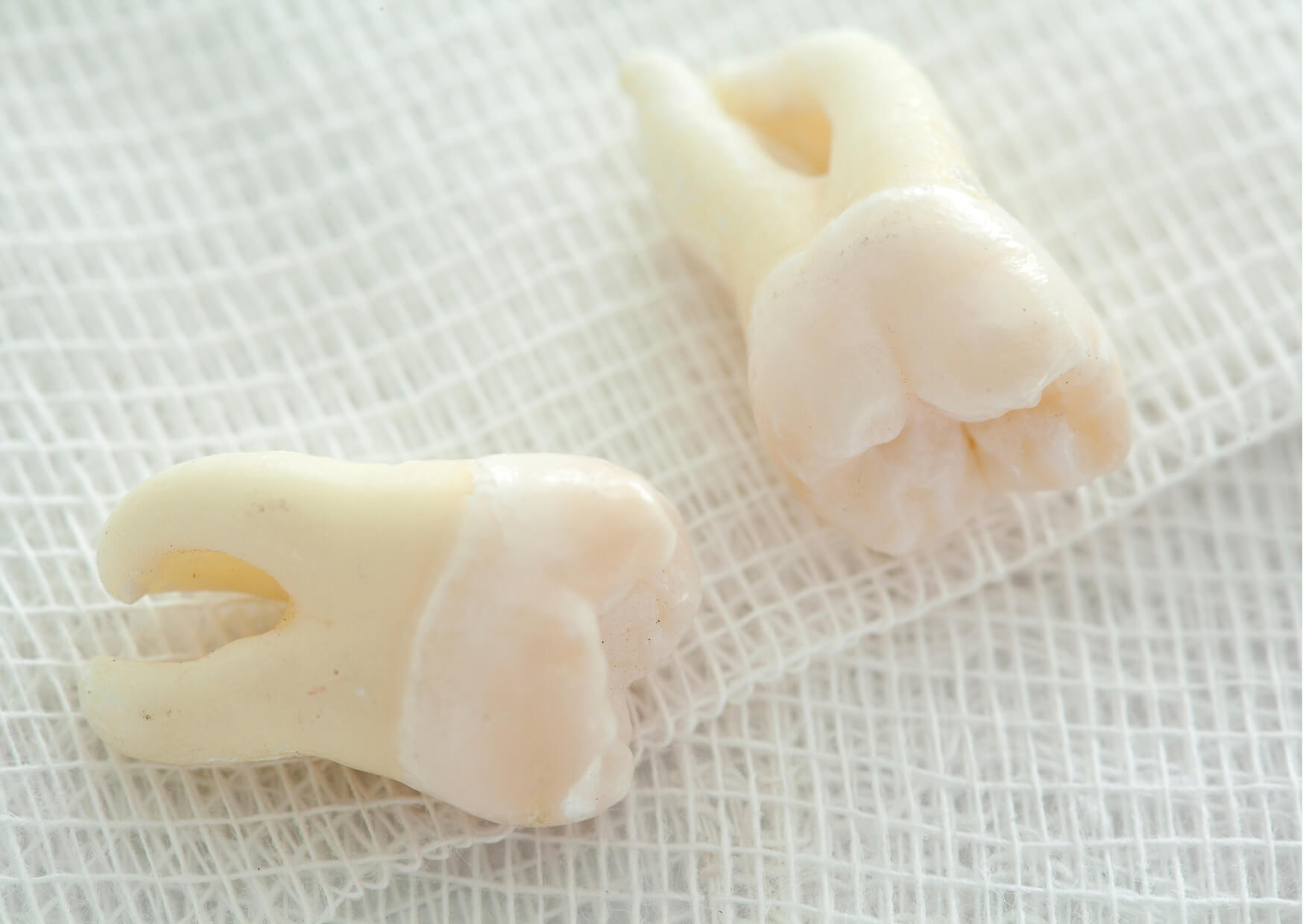 Extracted wisdom teeth displayed after oral surgery, demonstrating when wisdom teeth may need to be removed to protect oral health.